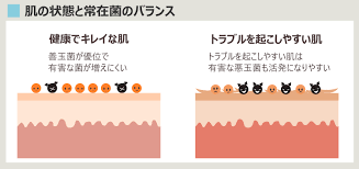 ニキビの化膿について