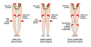 Bowlegs High School Ok Bow Legged Correction Bow Legged Knock Knees