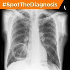 Right Sided Lung Abscess With Clear Air Fluid Level At Lower Segment Radiography Respiratory System Medical