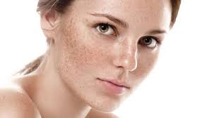 Image result for Freckled skin