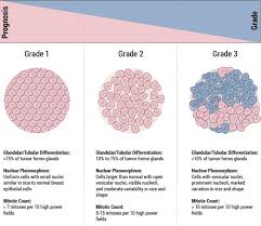 Whether it is present only in the inside lining of the colon or rectum, has grown. Staging Grade Breast Pathology Johns Hopkins Pathology