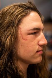 Syracuse teen Cole Cheney continues recovery from horrific dirt bike  accident