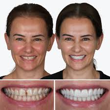 Porselen lamina e-max alt- üst çene birlikte gülüş tasarımı… Gülüşünüz  avantajınız olsun 💫🥰 @dentistryoscars #dişhekimi #dentist #lamina  #implant #smiledesign #botoks #botox #gülüştasarımı #porselendiş  #gülüşestetiği #smiledesign #bağdatcaddesi ...