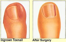 Image result for Toenail Removal