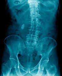 Meist sind auch die wirbelkörper verdreht. Skoliose Fehlstellung Der Wirbelsaule Gelenk Klinik De