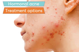 Once you begin taking birth control pills, it. Best Birth Control Pills For Women With Hormonal Acne Mdacne
