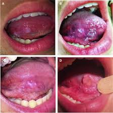 Image result for cancer of tongue