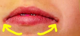 заеды в уголках рта причины и лечение у взрослых Zaedy V Ugolkah Rta U Rebyonka I Vzroslogo Prichiny I Sposoby Lecheniya Stomatolog Egor Shetinkin Yandeks Dzen