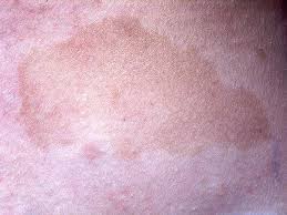Concerned about sons cafe au lait spots. Webpathology Com A Collection Of Surgical Pathology Images