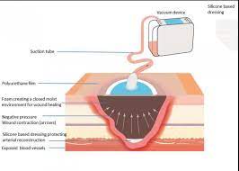 The therapy involves the controlled application of subatmospheric pressure to the local wound environment, using a sealed wound dressi. Faster And Better Healing Of Infected Wounds Using Negative Pressure Technique