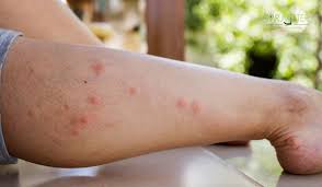 Image result for mosquito bite