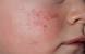 Fifth Disease Slapped Cheek