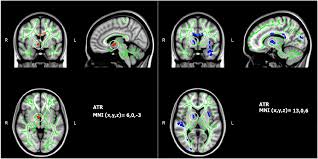 Autism spectrum disorder (asd) is a neurodevelopmental disorder characterized by deficits in social communication and social interaction and the presence of restricted, repetitive behaviors. Figure 4 From Characteristics Of Brains In Autism Spectrum Disorder Structure Function And Connectivity Across The Lifespan Semantic Scholar