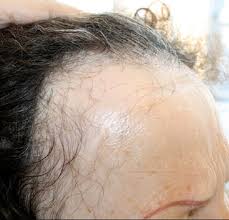 Frontal fibrosing alopecia causes the front hair line to have scarring hair loss thinning. Study Probes Corticosteroid Frontal Fibrosing Alopecia Treatment