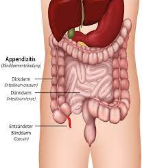 Ein abszess des blinddarms, der als appendizionaler abszess bezeichnet wird. Blinddarmentzundung Erkennen Symptome Selbsttest Op