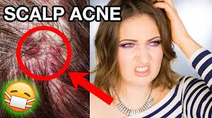 Entdecke rezepte, einrichtungsideen, stilinterpretationen und andere ideen zum ausprobieren. Scalp Acne Itchy Dandruff How To Get Rid Of It Completely Youtube
