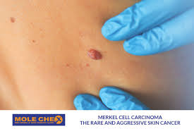 Image result for Merkel Cell Carcinoma