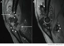 Pigmented Villonodular Synovitis Diagnostic Delay Due To Coexistence With Ankylosing Spondylitis Reumatologia Clinica