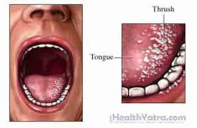 Image result for oral thrush symptoms roof of the mouth