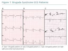 Current Controversies And Challenges In Brugada Syndrome Ecr Journal