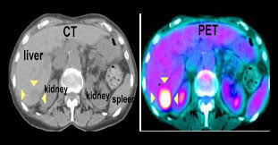 Positron is emitted during nuclear reactions. Pet Ct Scan Cost In Lucknow Ct Scan Machine
