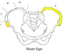 Image result for Risser Sign