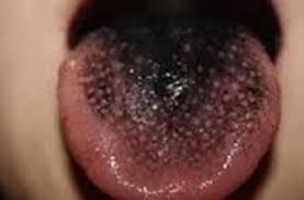 Image result for black hairy tongue symptoms