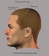 Review of Clinical Applications of Scalp Acupuncture for Paralysis: An  Excerpt from Chinese Scalp Acupuncture