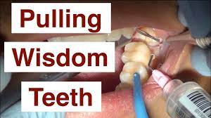 A common rite of passage—having your wisdom teeth pulled—might be raising the risk of teens and young adults becoming addicted to opioids, a new study out monday in jama internal medicine suggests. Pulling Wisdom Teeth Youtube