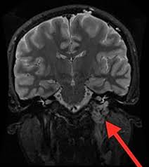In pulsatile tinnitus, people hear something resembling their heartbeat in their ear. A Case Of Pulsatile Tinnitus The Bmj