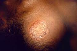 Signs And Symptoms Hansen S Disease Leprosy Cdc