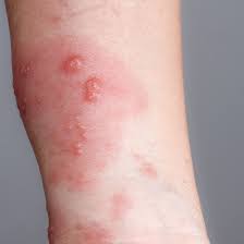 Image result for Rhus Dermatitis