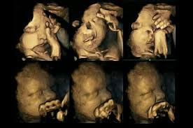 Merokok merupakan penyebab nomor satu dari berbagai penyakit kronis, seperti penyakit jantung. Gambar Ultrasound 4d Ini Menunjukkan Kesan Rokok Pada Janin