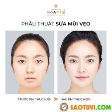 Tướng mũi thông thiên, mũi phục tê