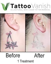 The tattoo starts behind the ear, follows the hairline and ends towards the back of the neck. Before And After Tattoo Removal Get The Best Results The All Natural Way Tattoo Removal Pictures Tattoo Vanish