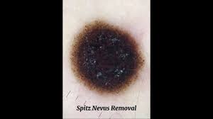 Image result for Spitz Nevus