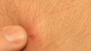 Also, ingrown hairs can cause serious complications if they become infected. Ingrown Hair Philadelphia Pa Main Line Pa Farber Dermatology