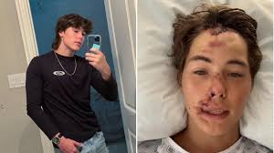 TikTok star Caleb Coffee breaks silence after falling onto lava rocks