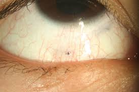 Image result for Conjunctival Foreign Body