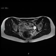 Mrkh syndrome belongs to class i mullerian duct anomalies. Mayer Rokitansky Kuster Hauser Syndrome Radiology Case Radiopaedia Org