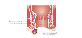 Image result for hemoroid human