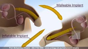 Image result for Penile Prosthesis