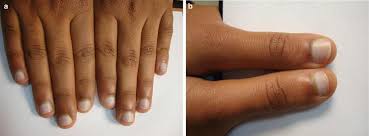 Chronic kidney disease (ckd) is characterized by an irreversible deterioration of renal function that gradually progresses to. Nail Diseases Among Renal Patients Springerlink