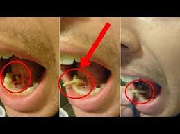 Obat sakit gigi berlubang dengan obat modern. Mengerikan Ketika Dokter Mengeluarkan Ulat Gigi Berlubang Youtube