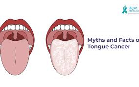 Image result for cancer of tongue