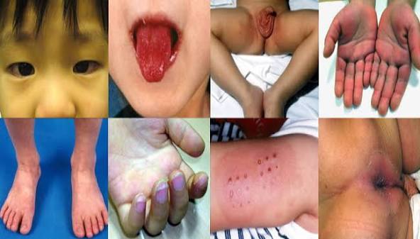 Penyakit Kawasaki - patofisiologi, diagnosis, penatalaksanaan - Alomedika