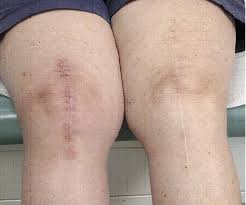 I don't want a frankenstein looking scar. Surgical Approaches For Total Knee Arthroplasty Intechopen