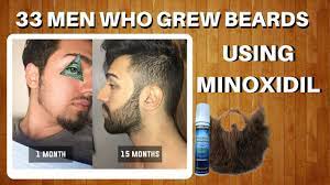 But the men who have. 33 Men Who Grew Beards Using Minoxidil The Minox Beard Spot Minoxidil Beard Showcase Youtube