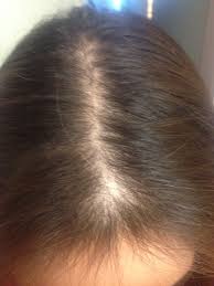This leads to the development of vellus (non pigmented fine hairs) which can be an early indication of deficiency. Sammysky2014 My Hair Thickening Regrow Project