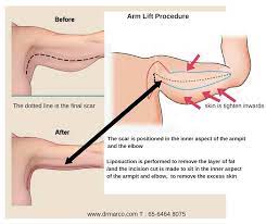 The cost of an arm lift varies by patient. Arm Lift Brachioplasty Dr Marco